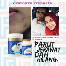 Jerawat batu merupakan jerawat yang jauh terbentuk di dalam kulit. Parut Jerawat Sudah Hilang