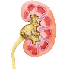 In some cases of kidney pain, there are a few simple steps to alleviate the pain in your back. Dr Dhir S 4 Tips For Kidney Stone Prevention Dhir Robert Htxurology Com