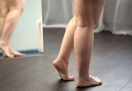 Ladies Here S What You Should Know About Lipedema A Condition That Causes Excess Fat In The Legs Health Essentials From Cleveland Clinic
