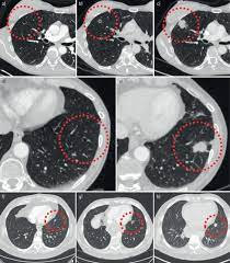 Anyone can develop lung cancer, but cigarette smoking and having exposure to smoke, inhaled chemicals, or other toxins can increase the. Cyst Related Primary Lung Malignancies An Important And Relatively Unknown Imaging Appearance Of Early Lung Cancer European Respiratory Society