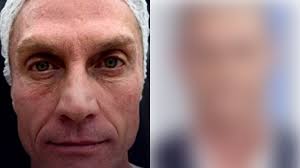 André Segatti surpreende ao exibir resultado de harmonização na TV: "Outra  pessoa"