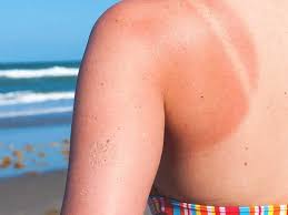 There are several types of sun allergy, all with different backgrounds and with different symptoms. Sunscreen Allergy Symptoms Treatment Prevention