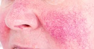 Image result for demodex rosacea