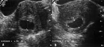 assessment of gestational age by ultrasound glowm