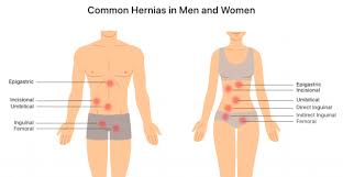 Image result for Inguinal hernia man