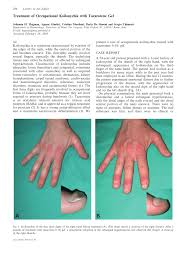 Home > foot conditions > damaged nails > kolinychia nails. Pdf Treatment Of Occupational Koilonychia With Tazarotene Gel