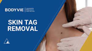 Anal Skin Tags Removal | Anal Tag Cautery