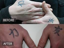 With the breadth of current technology available, tattoos don't have to be forever anymore! Laser Tattoo Removal Melbourne The Doc Clinic Hoppers Crossing
