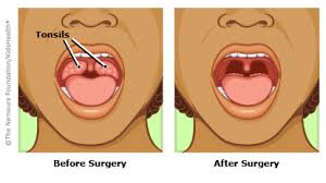 Cancer can develop in your tonsils. Having Your Tonsils Taken Out For Kids Nemours Kidshealth