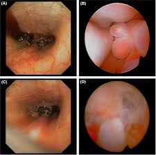 Find out about nasal polyps, which are painless soft growths inside your nose. Emergence Of Nasal Chondrosarcoma In A Dog With Nasal Polyposis Sumner 2018 Clinical Case Reports Wiley Online Library