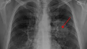 Lung Cancer Pictures: Ct Scan, X Ray, And More