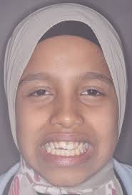 Class III skeletal, Open bite severe, orthodontic treatment pitts protocol,  short light elastics from the first day, tongue tamers. 8 months case  closed...