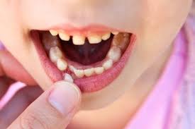 What To Do About A Loose Tooth Guelph Dentist Loose Tooth Baby Teeth Dental Problems