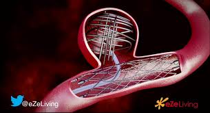 Aneurisma adalah pelebaran abnormal dari sebuah arteri yang berhubungan dengan kelemahan pada dinding arteri. Aneurisma Otak Bagaimana Penanganan Kasus Aneurisma Otak