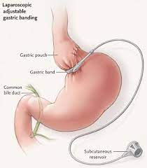 You can do it with noom. Laparoscopic Adjustable Gastric Band Surgery Agb Penn Medicine