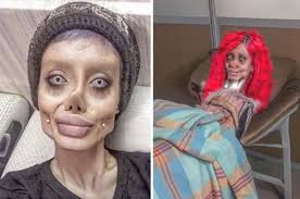 عمليات تجميل المهبل هو اسم عام يشمل عدة أنواع من العمليات غالبا ما تكون عمليات تجميل المهبل غير ضرورية، حيث نشرت مؤخرا نتائج دراسة رائدة حول موضوع عمليات تجميل المهبل. Ø´Ø§Ù‡Ø¯ ØµÙˆØ± ØµØ§Ø¯Ù…Ø© Ù„ÙØªØ§Ø© Ø£Ø¬Ø±Øª 50 Ø¹Ù…Ù„ÙŠØ© ØªØ¬Ù…ÙŠÙ„ Ù„ØªØ´Ø¨Ù‡ Ø£Ù†Ø¬Ù„ÙŠÙ†Ø§ Ø¬ÙˆÙ„ÙŠ