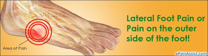 🦶do you have outside of the foot pain?🦶 we we have all the causes, symptoms & absolute best treatment options for your lateral foot pain. Pin On Joint Pain