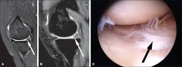 In other cases, it might take a few days. Scielo Brasil Diagnostic Performance Of 3d Tse Mri Versus 2d Tse Mri Of The Knee At 1 5 T With Prompt Arthroscopic Correlation In The Detection Of Meniscal And Cruciate Ligament
