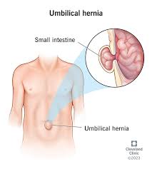 Image result for stomach hernia symptoms