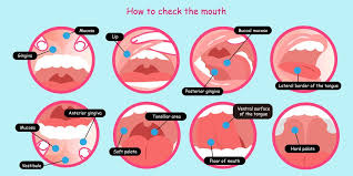 It's important to notice mouth cancer symptoms treatment options now are very limited. Oral Cancer Screenings Schultz Family Dental