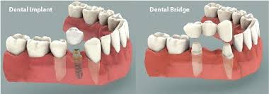 What S Better A Dental Implant Or A Bridge Lady S Island Sc Dentist