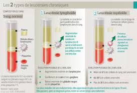 La leucémie aiguë est un stade de la maladie de la leucémie, cancer du sang. Leucemies Les Avancees Therapeutiques Sillc