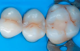 Image result for Occlusal