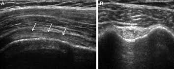 Image result for Biceps Tendon Injection