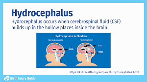 Image result for Hydrocephalus