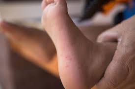 The most common type of infections that cause red spots on feet are athlete's foot fortunately, most causes of foot redness are benign and easily treatable, but some require evaluation and intervention by a medical professional. Hand Foot And Mouth Disease Symptoms Familydoctor Org