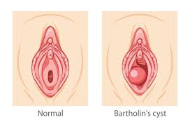 Image result for Bartholin's gland abscess