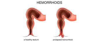 Image result for Hemorrhoid