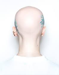 A look at alopecia universalis, a condition resulting in hair loss across the entire body. Alopecia Areata Spot Baldness Definition And Explanation