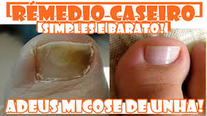 Antes de começar qualquer tipo de tratamento por conta própria, ao observar qualquer sinal, coloração ou textura diferente em suas unhas, procure imediatamente um médico dermatologista, pois ele identificará qual é o problema e lhe indicará 0 tratamento adequado. Incrivel Exterminador De Fungos Das Unhas Acabe De Vez Com A Micose Nas Unhas Fran Adorno Youtube