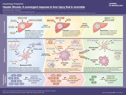 In the process, scar tissue forms. Hepatic Fibrosis A Convergent Response To Liver Injury That Is Reversible Journal Of Hepatology