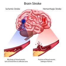 If extremity weakness occurs with or without headache, a stroke evaluation. What Does A Stroke Related Headache Feel Like Premier Neurology Wellness Center