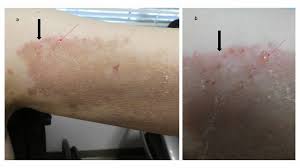 Cureus Dyshidrosiform Bullous Pemphigoid Case Reports And Review