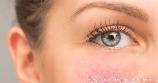 Tagtägliche arbeit im freien fördert gesichtsäderchen, genauso wie kälte, hitze, scharfes essen. Rosacea Symptome Behandlung Pflege Netdoktor