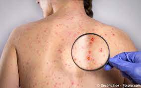 Roteln Rubella Symptome Diagnostik Therapie Gelbe Liste