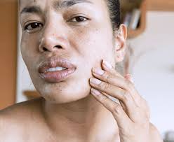 Image result for Dry Skin