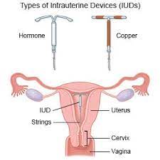 If you can't feel the string, the string feels shorter or longer than the last time you checked, or if you feel any hard plastic, then get your iud checked by a health care provider. Intrauterine Device What You Need To Know