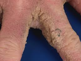 Image result for scabies norvegica