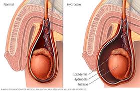However, for many men, these problems are temporary. Scrotal Masses Symptoms And Causes Mayo Clinic