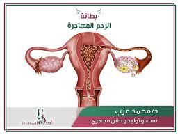 بطانة الرحم المهاجرة منتشرة بين السيدات Dr Mohamed Azab Clinic Facebook