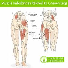 Image result for Functional Leg Length Discrepancy