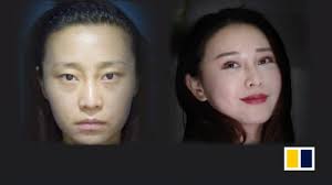 Particularly if the patient wants a higher, more defined bridge, an asian nose job usually focuses on augmentation and creating tip definition. Internet Users Angered Over Light Penalty Handed Down To Illegal Clinic That Destroyed Chinese Star Gao Liu S Face South China Morning Post