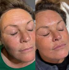 0.5ml flat lips for this gorgeous girl😍 in this video you see the before,  filled & glossed versions of this clients lip treatment💉 We used  @kairax_uk in DEEP💙 for this transformation &