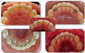 Fixed Orthodontic Retainer Google Search Cheap Dental Service Orthodontics Orthodontics Invisalign Braces Colors