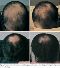 Furthermore, androgenic alopecia is the most common form of hair loss which affects both men and women according to the evidence that we find from a study of men in northeastern germany. Botox Injections For Hair Growth In Men Hairguard