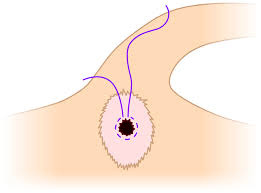 Image result for Purse String Suture